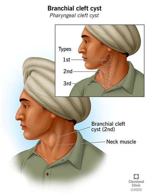 Branchial Cleft Cyst: Symptoms, Types & Treatment