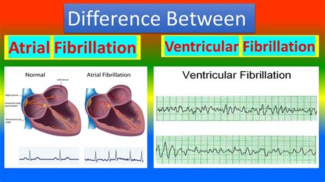 Ventricular Flutter Vs Fibrillation