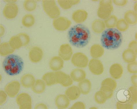 Leukocyte alkaline phosphatase (LAP)scoring - 3.