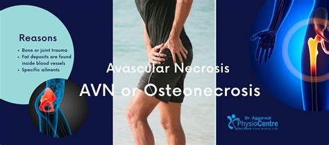 Avascular Necrosis (AVN) Treatment without Surgery in Noida