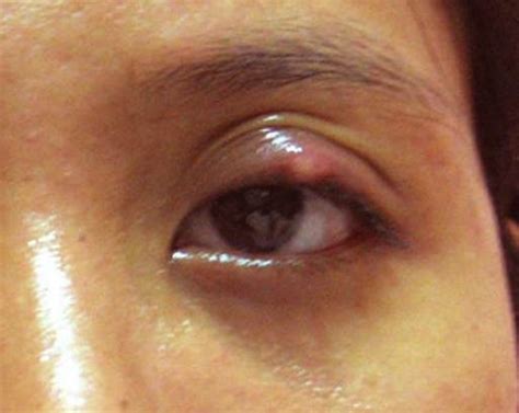 Bump on Eyelid - Symptoms, Causes, Treatment, Pictures