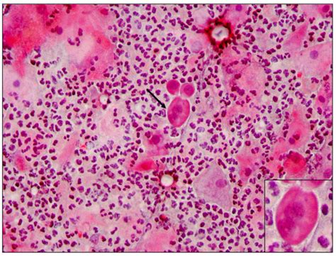 PAP SMEAR SHOWING LSIL. PAP STAINING IN A PATIENT WITH LSIL SHOWING ...