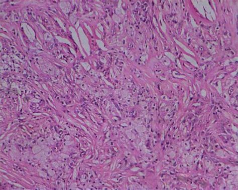 Histology of Xanthoma. Histology picture of xanthoma showing lipid ...