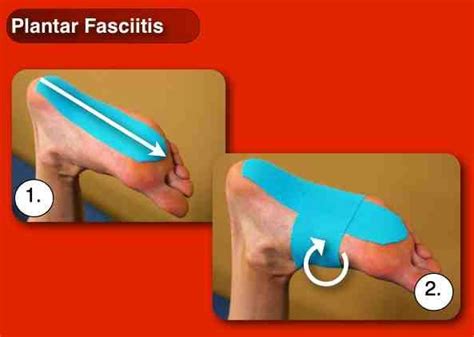 Kinesiology Taping for Plantar Fasciitis - RockTape Canada ...