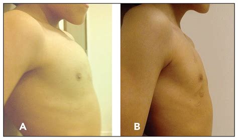 Clinical experience with orthotic repair of pectus carinatum | Annals of Saudi Medicine