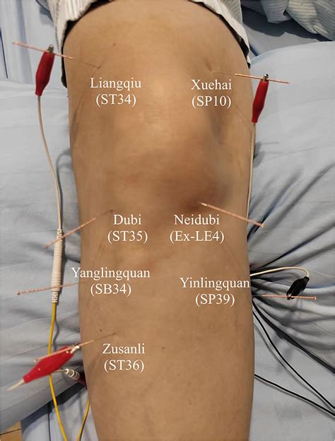 Frontiers | Case report: Electroacupuncture for acute pain flare-up of ...