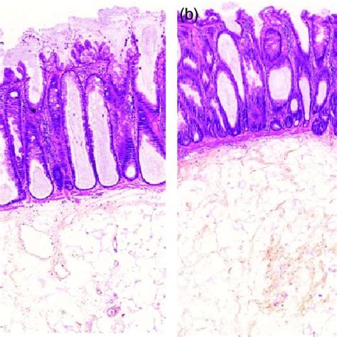 Typical histological images of sessile serrated adenoma without... | Download Scientific Diagram