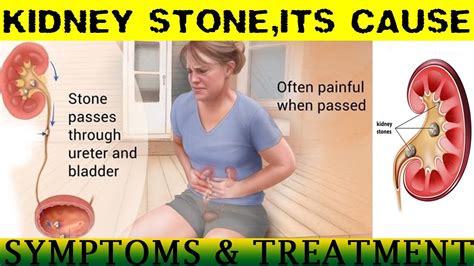 kidney stone -cause,symptoms,prevention - YouTube