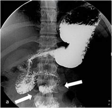 An unexpected cause of small bowel obstruction in an adult patient ...