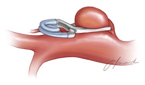 Posterior Communicating Artery Aneurysm | The Neurosurgical Atlas