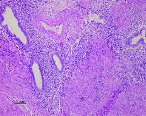 Histology connirmation for myometrium with adenomyosis. The myometrial ...