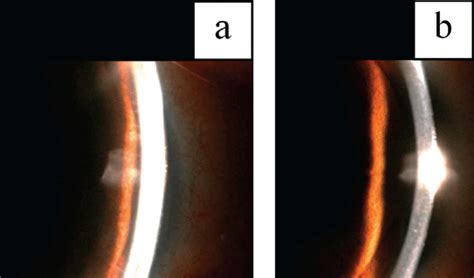 Two adequately illuminated slit-lamp sample images of type 1. Figure 10... | Download Scientific ...