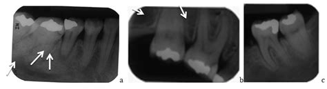 Periodontal Ligament Space Radiograph