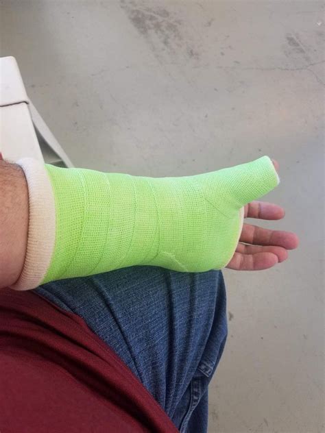 Green thumb spica cast | Arm cast, It cast, Scaphoid fracture