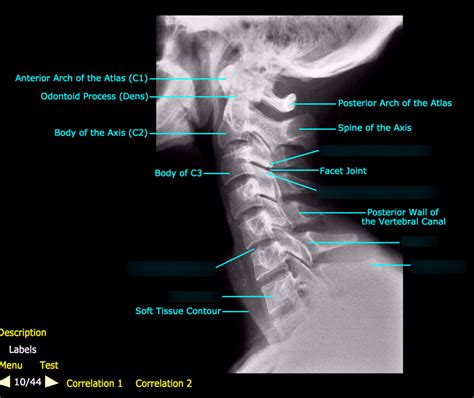 Cervical Spine Lateral View