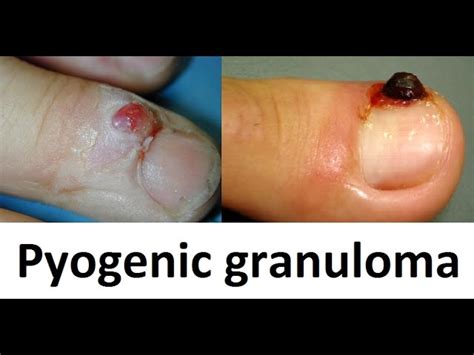 Pyogenic Granuloma Nail