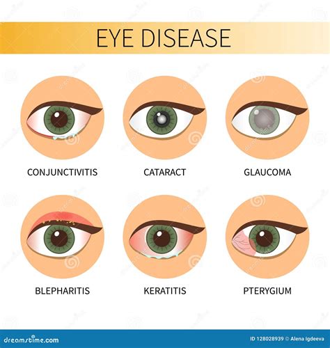 Infographic eyes disease stock vector. Illustration of health - 128028939