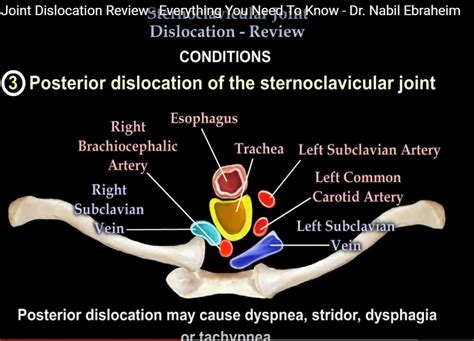 Sternoclavicular dislocation — OrthopaedicPrinciples.com