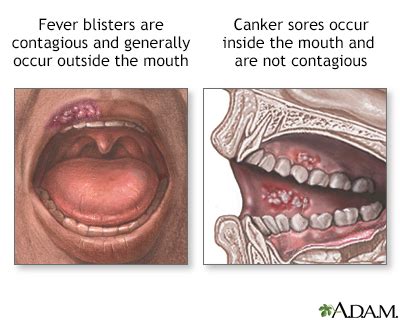 Canker sore Information | Mount Sinai - New York