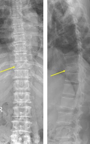 Spinal tuberculosis – Radiology Cases