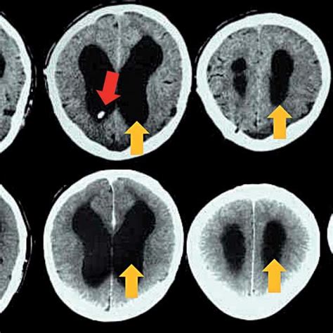 Normal Pressure Hydrocephalus (nph) 94B