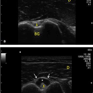 Ultrasound appearance of normal and degenerated Supraspinatus Tendon.... | Download Scientific ...