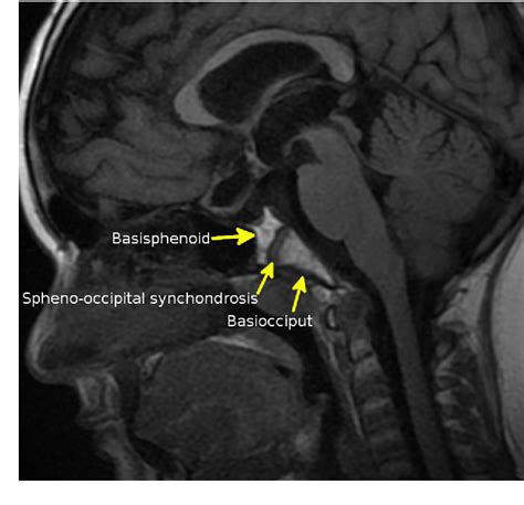 Figure 1 from Benign and malignant diseases of the clivus. | Semantic Scholar