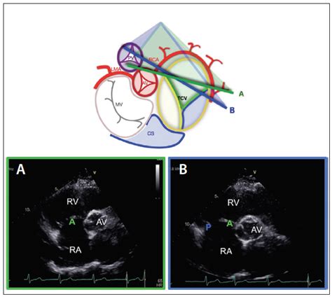 Echocardiography for Tricuspid Valve Intervention - Cardiac Interventions Today