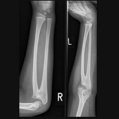 [Figure, Radioulnar Synostosis. Plain radiography of...] - StatPearls ...