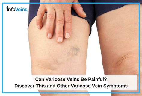 Can Varicose Veins be Painful? | Azura Vascular Care