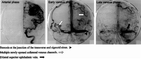 Cerebral angiogram dated 2000. There has been no significant change in ...