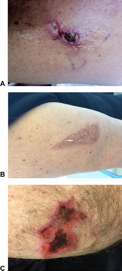 References in Subcutaneous Immunotherapy Induced Local Skin Necrosis ...