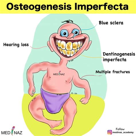 Osteogenesis Imperfecta - Medinaz HighYield Notes