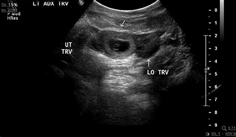 Ectopic Pregnancy Ultrasound