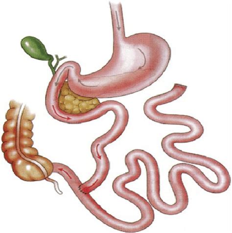 Traditional jejunoileal bypass schematic highlighting bypassed small ...