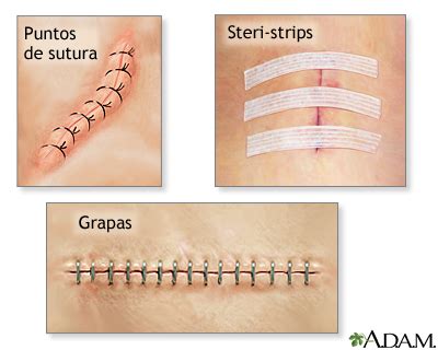 Cierres de incisiones: MedlinePlus enciclopedia médica
