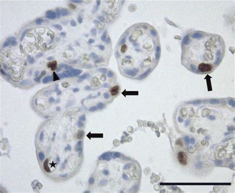 Proliferative activity of cytotrophoblast (arrows), stromal cell ...