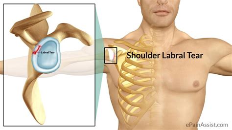 Shoulder Labral Tear - Motus Physical Therapy