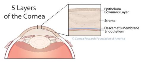 Cornea Research Foundation of America - Descemet's Stripping Only (DSO)