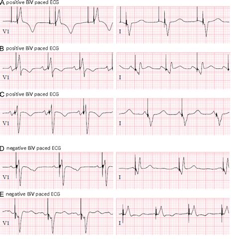 Prominent R wave in ECG lead V1 predicts improvement of left ventricular ejection fraction after ...