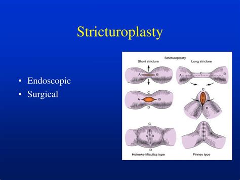 PPT - Crohn’s Colitis PowerPoint Presentation, free download - ID:5126875