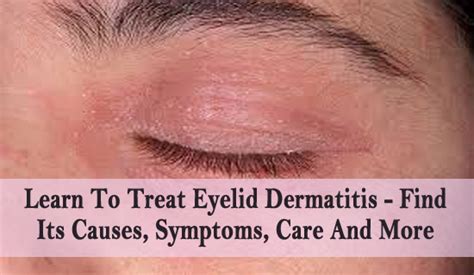 #eczemasymptomsandtreatment | Eyelid dermatitis, Eczema on eyelids, Eye ...