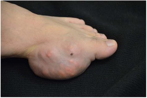 Frontiers | Tophaceous Gout – Even Today | Immunology