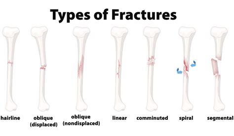 Understanding the Different Types of Bone Fractures - Comprehensive Orthopaedics