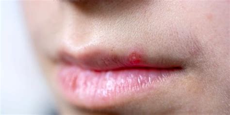 7 tips to make a lip pimple disappear quickly | Flipboard