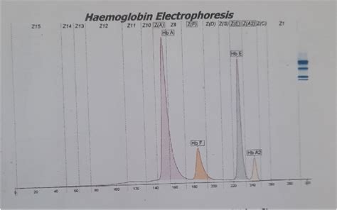 Hemoglobin electrophoresis showed decreased Hb A fraction, increased Hb ...