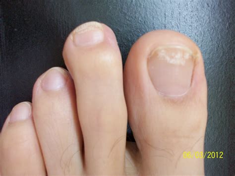 Images of toenail fungus - Awesome Nail