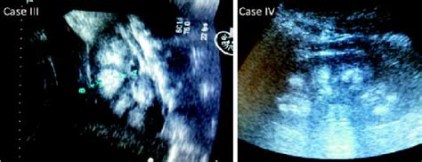 Medullary nephrocalcinosis at renal ultrasound. | Download Scientific Diagram