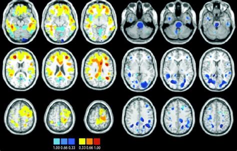 Bipolar Disorder Diagnosis May Soon Include MRI Brain Scan Test