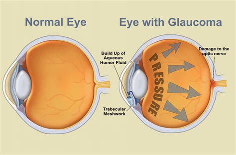 VISIQUE KAPITI EYECARE: July is Glaucoma Awareness Month